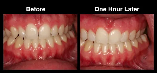 Chadds Ford Bonding and Tooth Reshaping