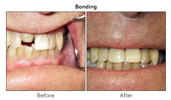 Chadds Ford Bonding and Tooth Reshaping