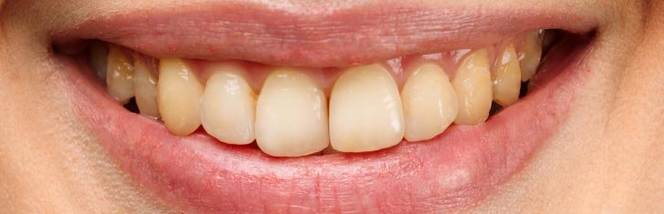 Before Dental Treatment